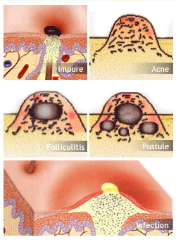 Transformation of Impure, Blackheads, Acne and Pustules