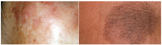 Pigmentation Skin