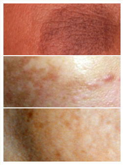 Pigmentation Skin